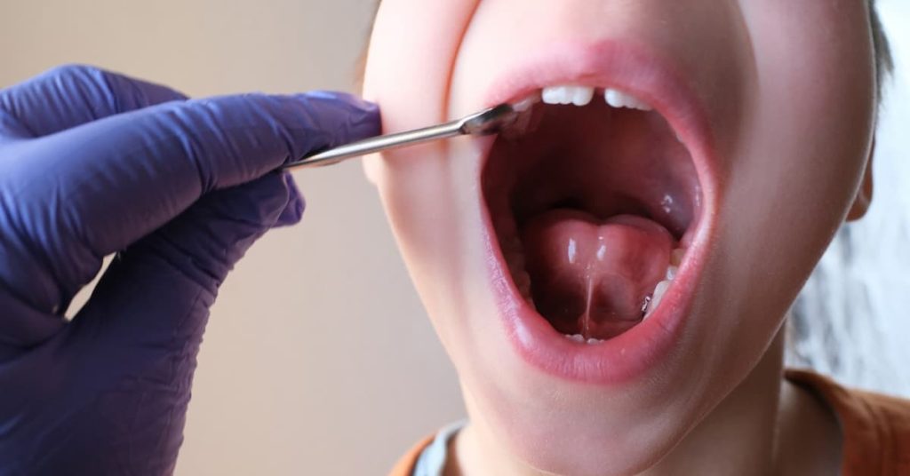 frenillo corto lingual como tratarlo